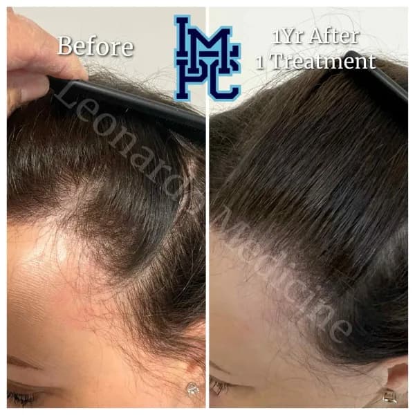 PRP Hair Treatment case 8