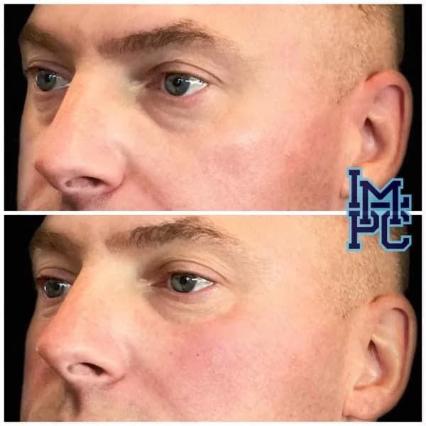 Radiesse® treatment 1