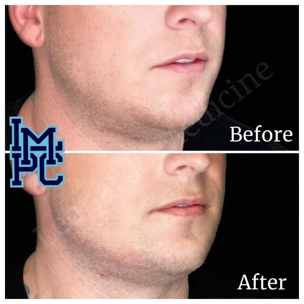 Radiesse® treatment 11