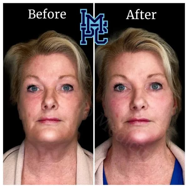 Radiesse® treatment 12