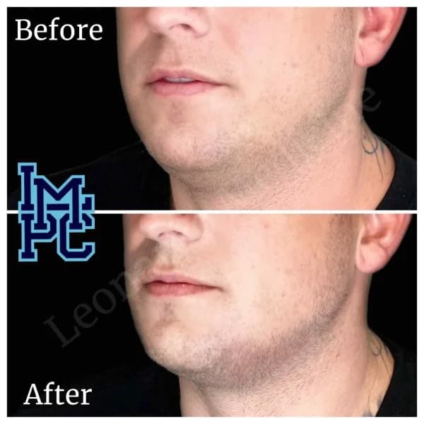 Radiesse® treatment 13