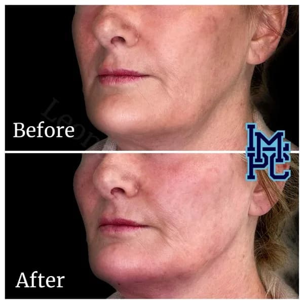 Radiesse® treatment 14