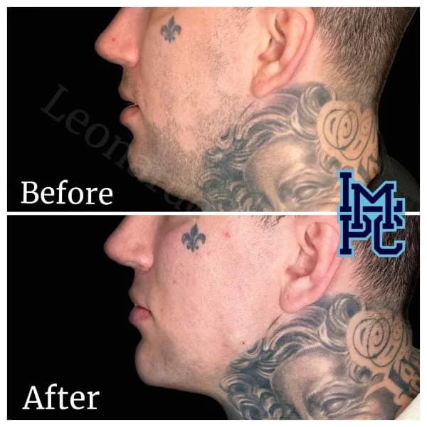 Radiesse® treatment 15