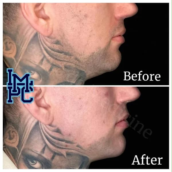 Radiesse® treatment 16