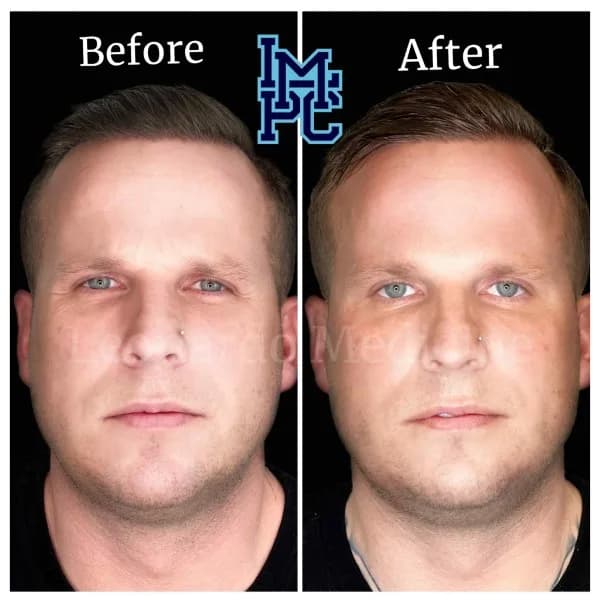 Radiesse® treatment 17