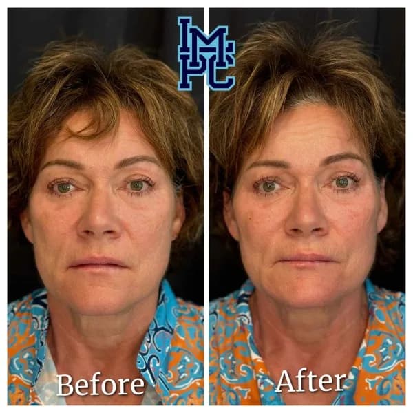 Radiesse® treatment 18