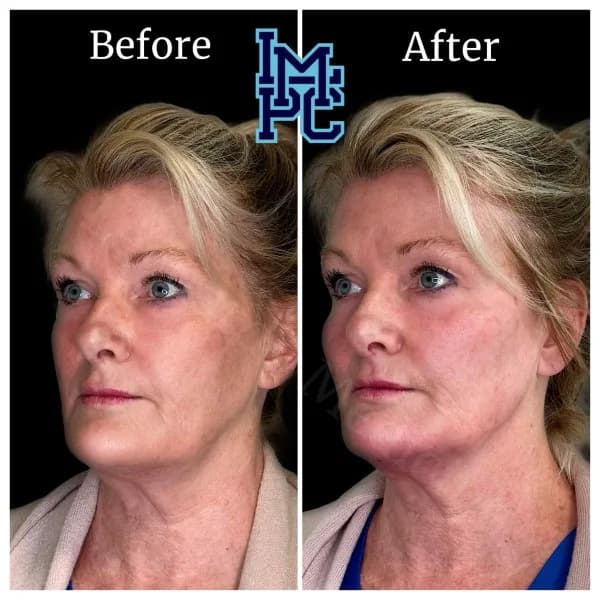 Radiesse® treatment 19