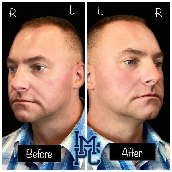 Radiesse® treatment 2