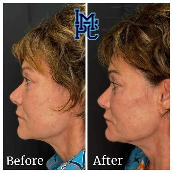 Radiesse® treatment 21