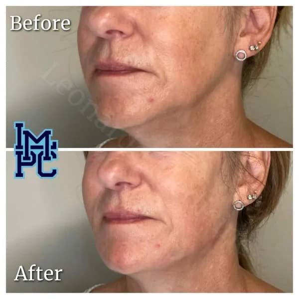 Radiesse® treatment 22