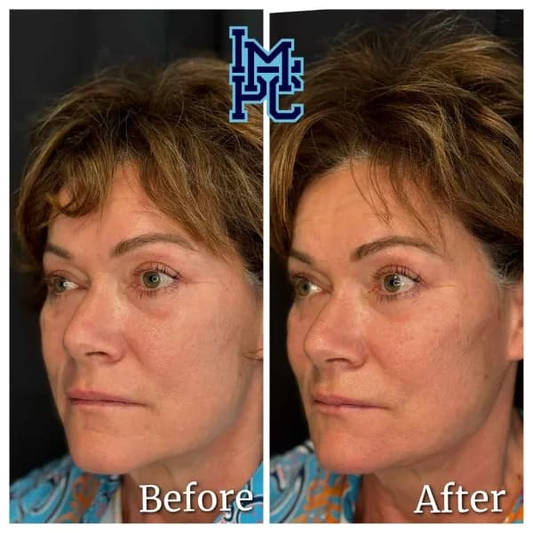 Radiesse® treatment 23