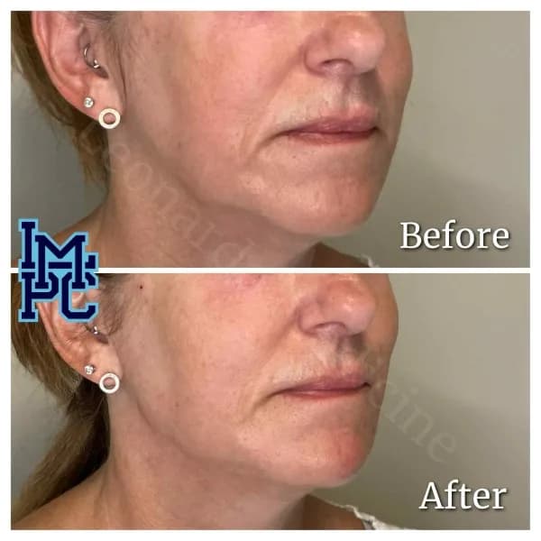 Radiesse® treatment 24