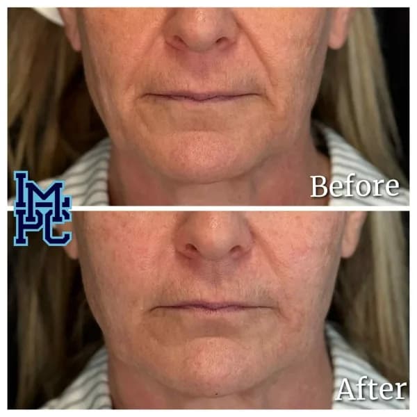 Radiesse® treatment 25