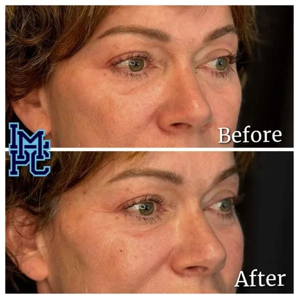 Radiesse® treatment 26