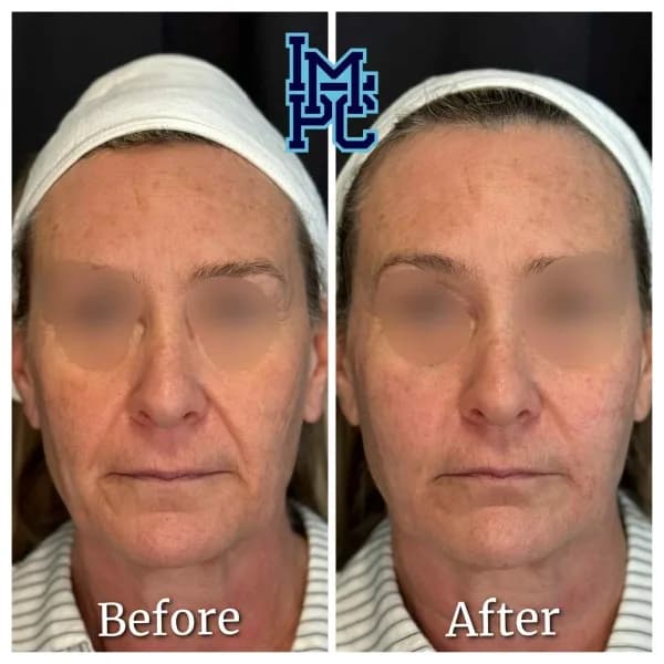 Radiesse® treatment 27