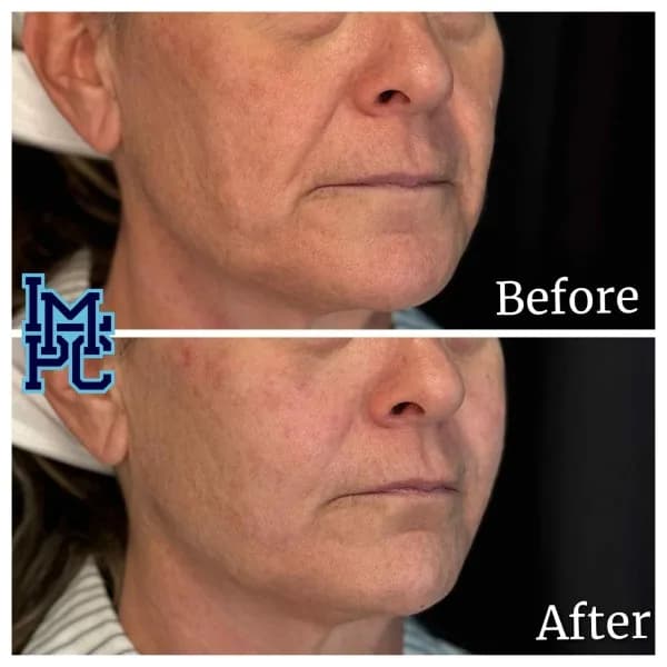 Radiesse® treatment 28