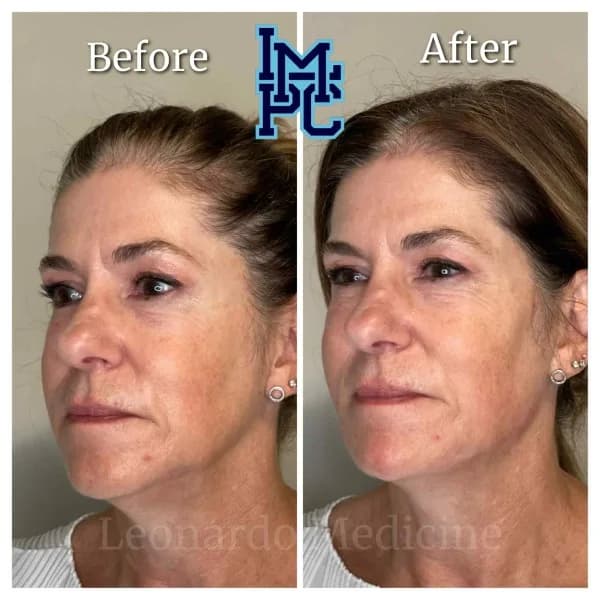 Radiesse® treatment 29