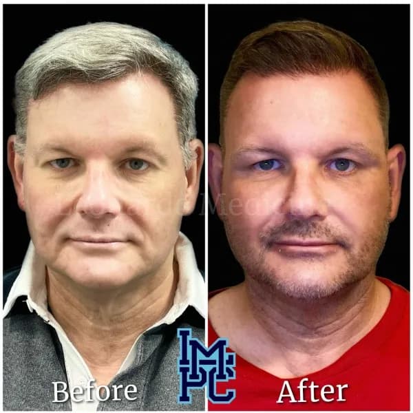 Radiesse® treatment 3