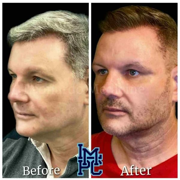 Radiesse® treatment 5