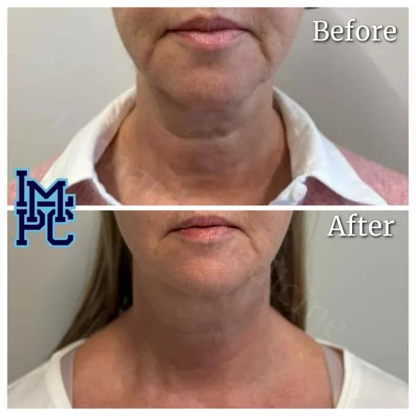 Radiesse® treatment 6