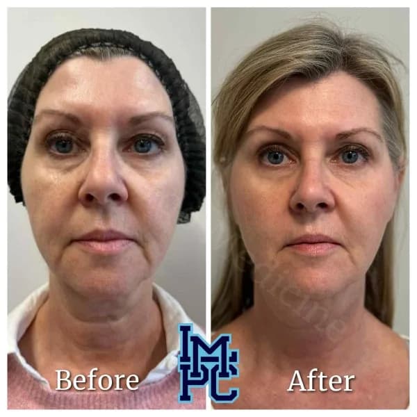 Radiesse® treatment 8