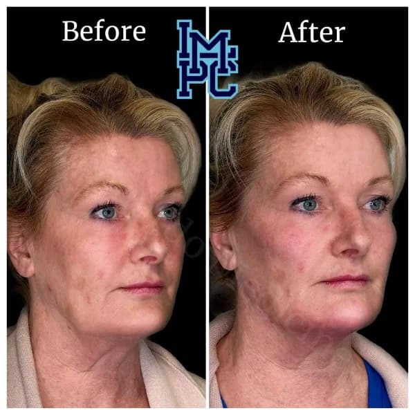 Radiesse® treatment 9