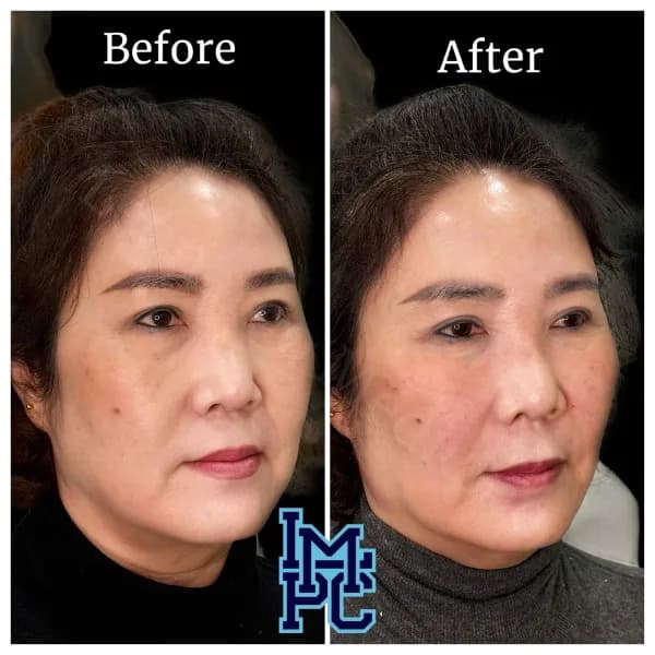 Sculptra® treatment 1