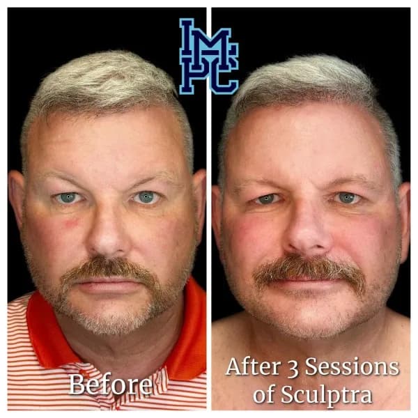 Sculptra® treatment 10