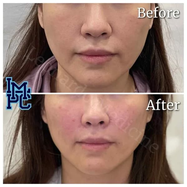 Sculptra® treatment 2