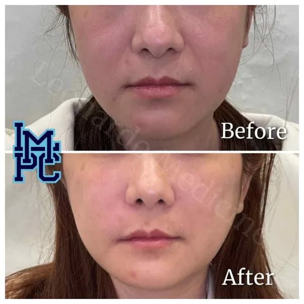 Sculptra® treatment 3