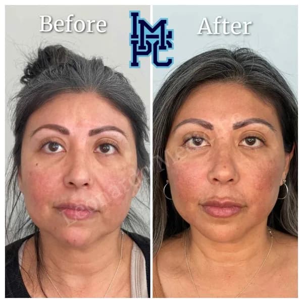 Sculptra® treatment 4