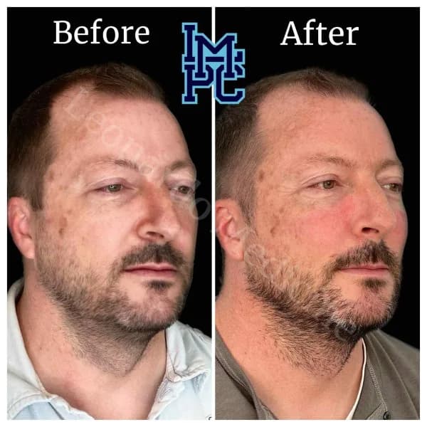 Sculptra® treatment 5