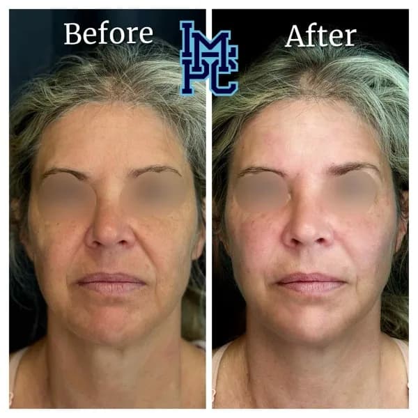 Sculptra® treatment 6