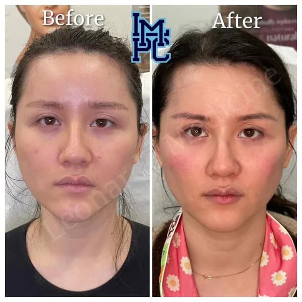 Sculptra® treatment 7