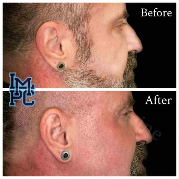 Sculptra® treatment 8