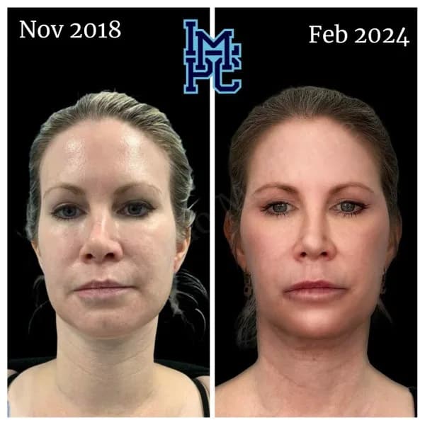 Sculptra® treatment 9